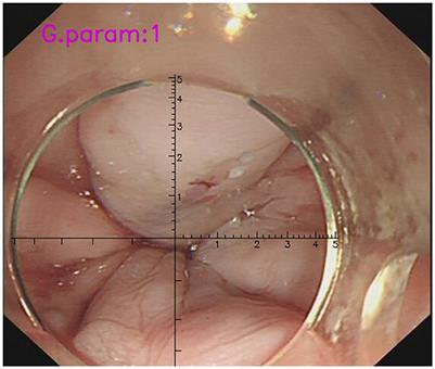 Correlation between the diameter of esophageal varices measured using a virtual ruler under endoscopy and portal pressure gradient